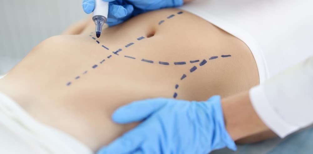 abdominoplasty perth